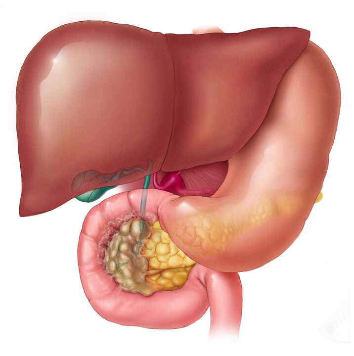 How to eliminate liver parasites